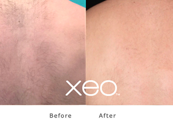 Before and after laser hair treatment on darker coloured skin using a ND Yag laser